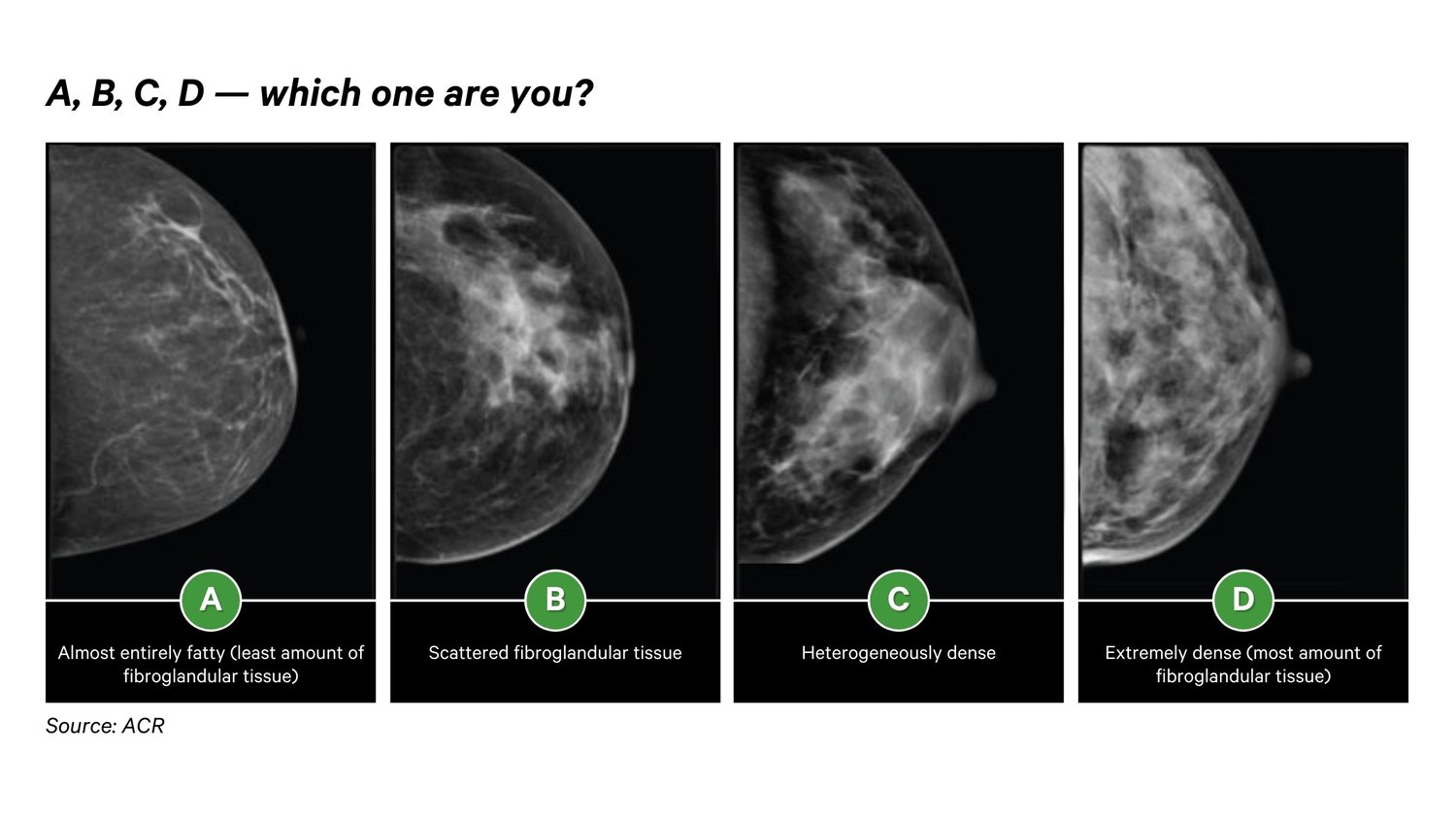 Know Your Breast Density Know Your Cancer Risk How Ai Helps Patients 4724